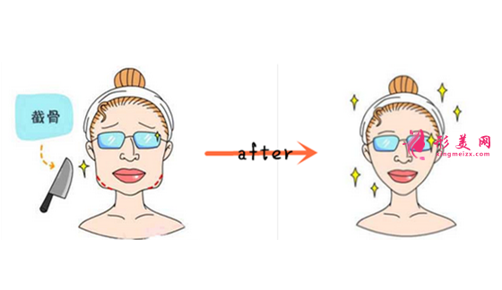 韓國(guó)下頜角手術(shù)效果 韓國(guó)下頜角手術(shù)效果