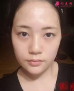 廣西醫(yī)科大第一附屬醫(yī)院瘦臉針案例效果圖！附2021價格標準