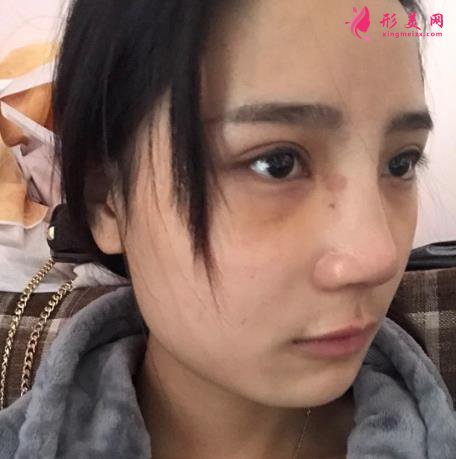 鄭州大學第一附屬醫(yī)院整形科怎么樣？隆鼻價格及恢復效果展示