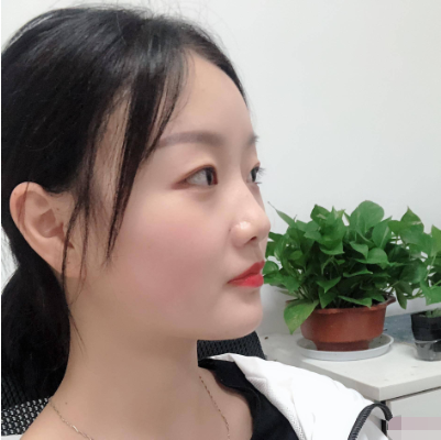 上海九院整形科蘇薇潔雙眼皮怎么樣？真實案例和價格表一起瞧瞧~