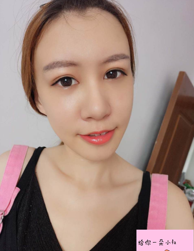 北京純脂馮斌脂肪填充怎么樣?看看術(shù)后效果怎么樣? 北京純脂馮斌脂肪填充怎么樣?看看術(shù)后效果怎么樣?