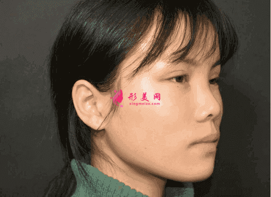 南昌時光整形是三甲醫(yī)院嗎？附玻尿酸隆鼻效果對比及2021價格表發(fā)布