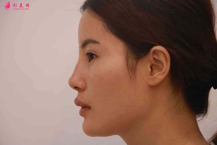 北京壹加壹醫(yī)院正規(guī)嗎？附隆鼻案例及2021價(jià)格表發(fā)布