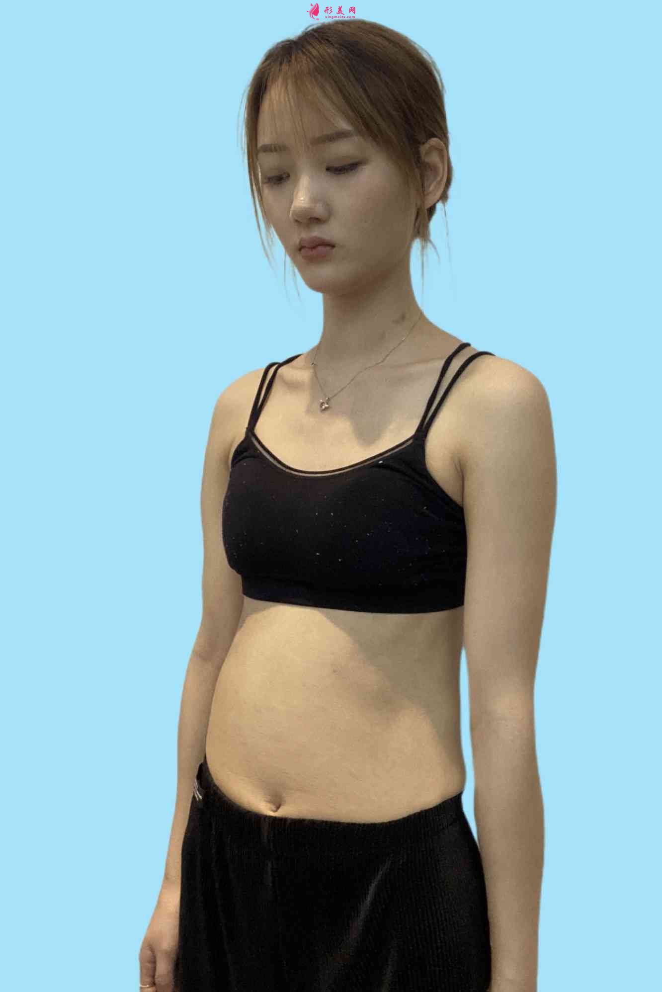 沈陽(yáng)軍區(qū)總醫(yī)院整形科屬于公立醫(yī)院?jiǎn)?？附吸脂案例?021價(jià)格表公開(kāi)