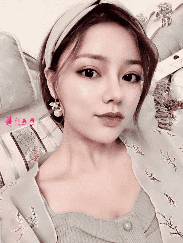 北京八大處隆鼻價格表一覽及隆鼻真人案例分享 北京八大處隆鼻價格表一覽及隆鼻真人案例分享