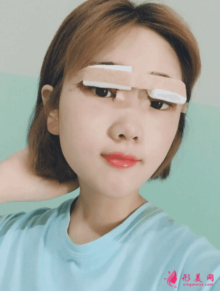 北京八大處雙眼皮多少錢？雙眼皮前后圖片對比+2021價格表曝光