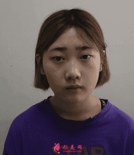 北京八大處雙眼皮多少錢？雙眼皮前后圖片對比+2021價格表曝光