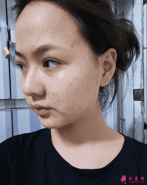 北京三院雙眼皮價(jià)格？附雙眼皮案例及2021價(jià)格表公開