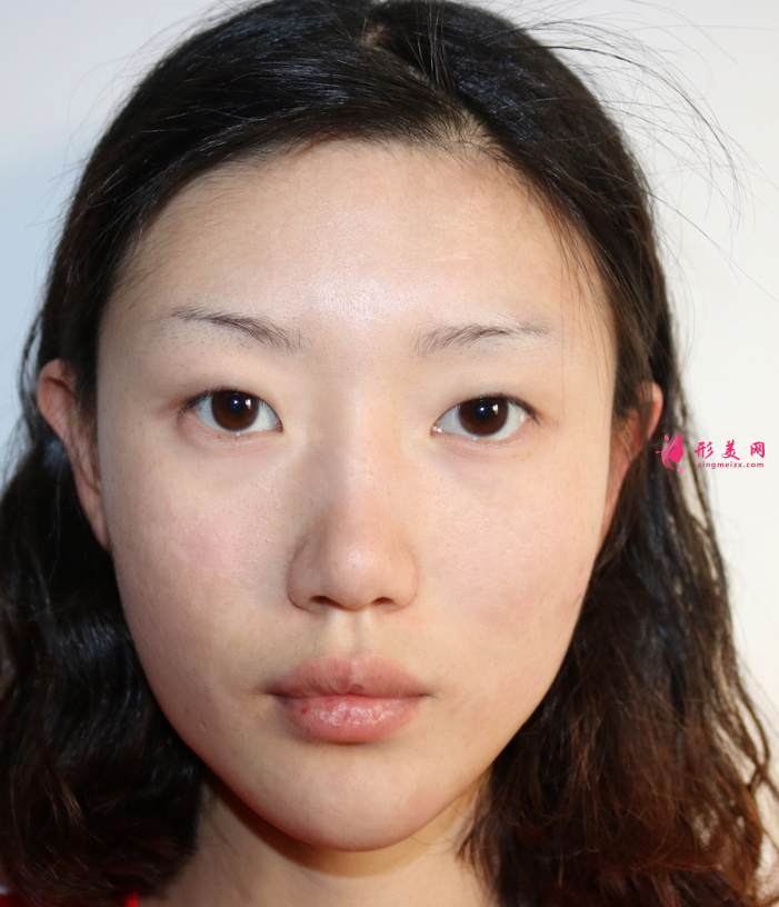 南陽(yáng)中心醫(yī)院整形科割雙眼皮怎么樣？附雙眼皮案例及2021價(jià)格表