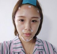 秦皇島市中醫(yī)院醫(yī)學美容科自體脂肪全臉填充案例一覽！含全新價格