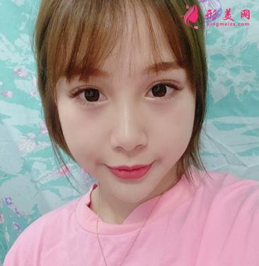 秦皇島市中醫(yī)院醫(yī)學(xué)美容科自體脂肪全臉填充案例一覽！含全新價格表展示