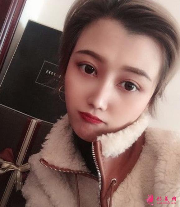 南京醫(yī)科大整形醫(yī)院埋線雙眼皮好嗎？無P圖美顏案例在此