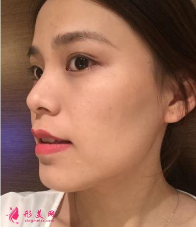 福州海峽美容醫(yī)院去眼袋怎么樣？技術(shù)特色、案例、價格收費(fèi)雙雙公開