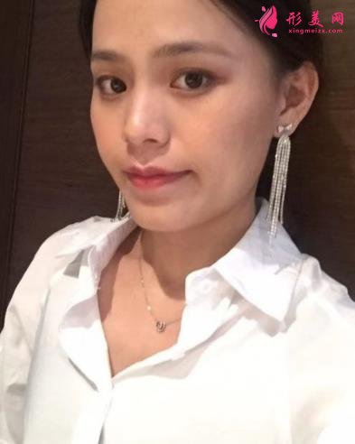 福州海峽美容醫(yī)院去眼袋怎么樣？技術(shù)特色、案例、價格收費(fèi)雙雙公開