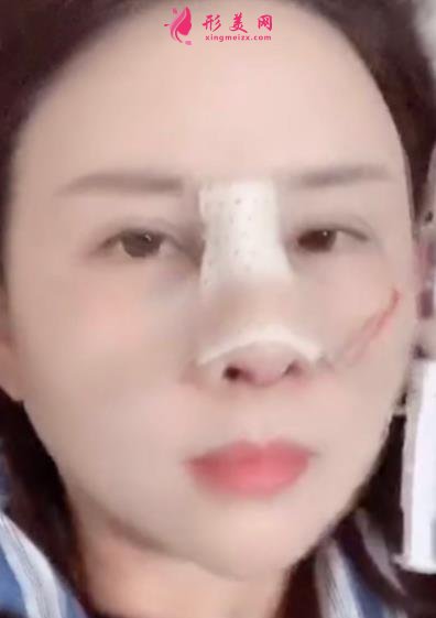 南京鼻祖整形醫(yī)院怎么樣？案例前后變化圖及隆鼻價(jià)格價(jià)目表分享