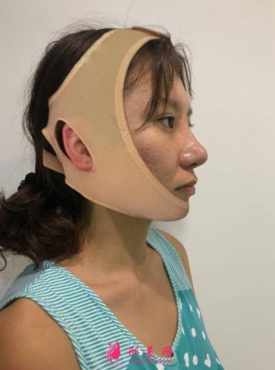 廣州廣大整形醫(yī)院面部輪廓價(jià)格價(jià)目表公開(kāi)!含實(shí)拍案例圖分享!