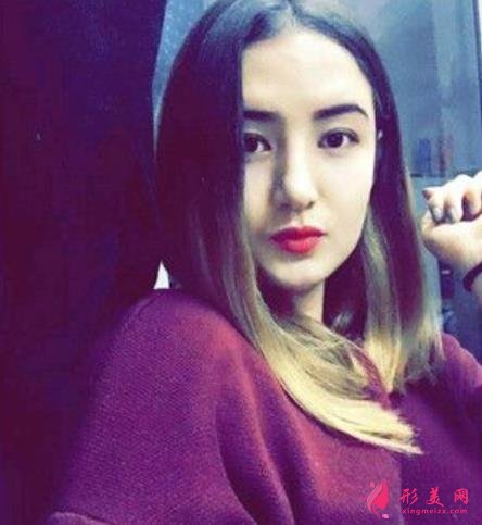 河南整形醫(yī)院鼻綜合恢復(fù)過程分享，不化妝無美顏不修圖的案例在此