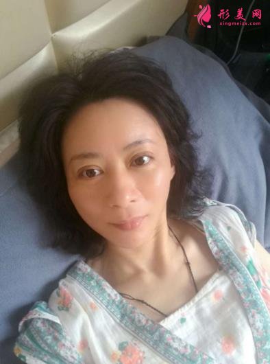 北京瑞麗馮立哲多維拉面部提升怎么樣？案例及效果圖公開查詢