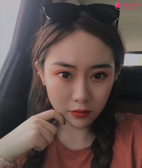 四川友誼醫(yī)院整形科隆鼻咋樣？案例術后效果價格收費曝光~