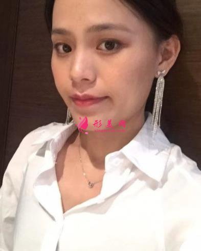 福州海峽美容醫(yī)院去眼袋怎么樣？技術(shù)特色、案例、價格收費雙雙公開