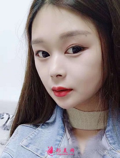 北京加減美面部拉皮提升怎么樣？手術(shù)案例及價(jià)目表2021