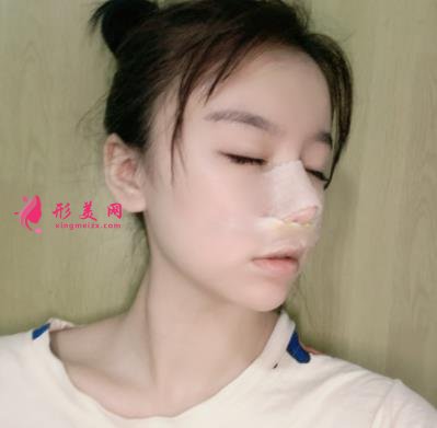 蘇州昆山百達麗醫(yī)療美容靠譜嗎？做鼻子真實案例及價目表_口碑介紹