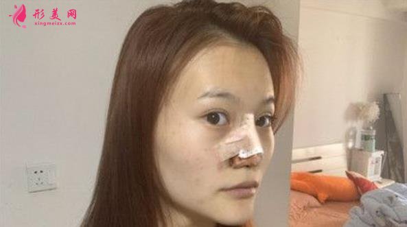 浙一醫(yī)院鼻綜合手術(shù)案例分享!鼻翼縮小術(shù)價(jià)格是多少錢(qián)?