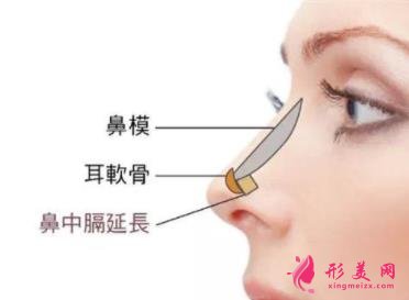 浙一醫(yī)院鼻綜合手術(shù)案例分享!鼻翼縮小術(shù)價(jià)格是多少錢(qián)?