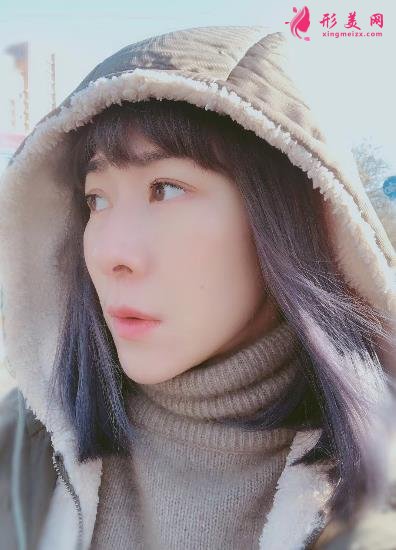 蘭州市第二人民醫(yī)院整形科全切雙眼皮案例效果分享！前后變化太贊了