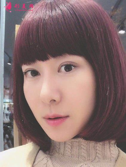 蘭州市第二人民醫(yī)院整形科全切雙眼皮案例效果分享！前后變化太贊了