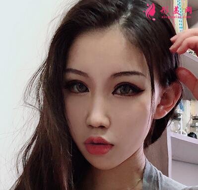 成都八大處整形醫(yī)院隆鼻案例曝光！還有價(jià)格收費(fèi)明細(xì)參考