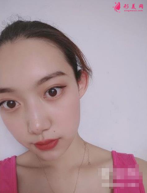 北京純脂孫澤芳面部填充脂肪案例反饋!整形價格全面一覽