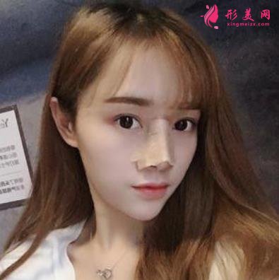 臺州恩澤醫(yī)院整形科隆鼻怎么樣？2021價格價目表+案例恢復(fù)日記分享