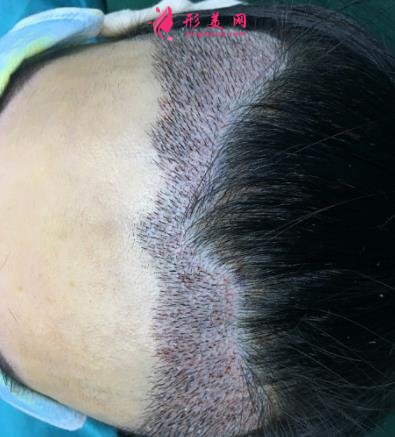 寧波市第六醫(yī)院整復(fù)外科種植發(fā)際線怎么樣？請看案例前后圖片及價(jià)格收費(fèi)