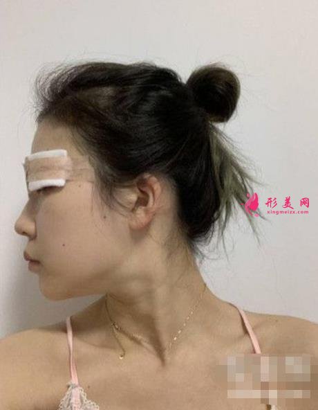 山大二院何茂文醫(yī)生做的雙眼皮咋樣?案例效果價(jià)格收費(fèi)表公開(kāi)