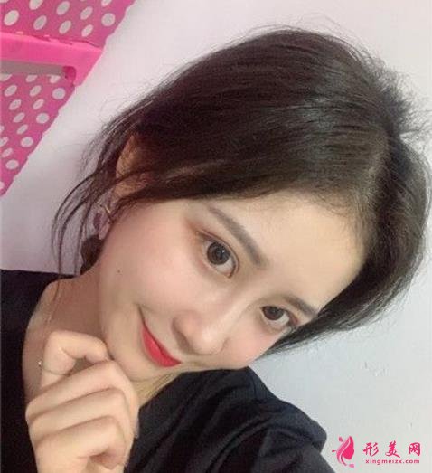 山大二院何茂文醫(yī)生做的雙眼皮咋樣?案例效果價(jià)格收費(fèi)表公開(kāi)