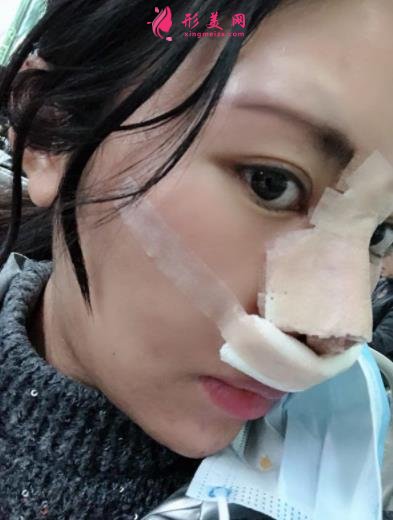 成都新麗美整形醫(yī)院隆鼻怎么樣？口碑案例和正規(guī)費(fèi)用（價(jià)格表）一覽