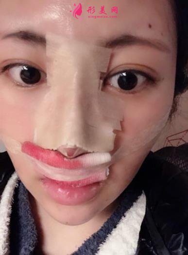 成都新麗美整形醫(yī)院隆鼻怎么樣？口碑案例和正規(guī)費(fèi)用（價(jià)格表）一覽