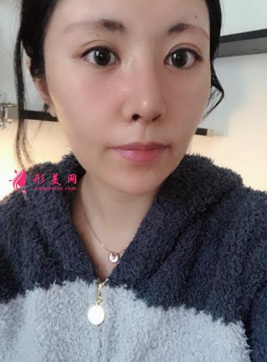 成都新麗美整形醫(yī)院隆鼻怎么樣？口碑案例和正規(guī)費(fèi)用（價(jià)格表）一覽