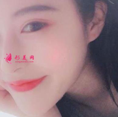 杭州整形醫(yī)院(杭州手外科醫(yī)院）做隆鼻怎么樣？專(zhuān)家案例及價(jià)格價(jià)錢(qián)表反饋