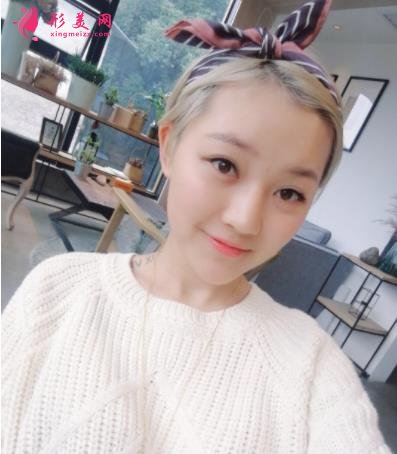 成都潤美玉之光整形怎么樣？自體脂肪全臉填充案例和真實(shí)價(jià)格價(jià)目分享