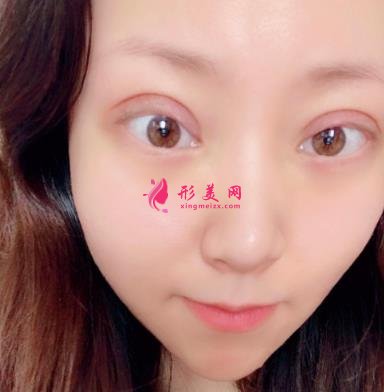天津公安醫(yī)院雙眼皮怎么樣？手術(shù)恢復(fù)過程分享_價格在線查詢