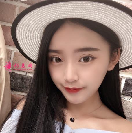 北京協(xié)和醫(yī)院雙眼皮多少錢？真人效果術(shù)后圖、價(jià)格表清單一一公布！