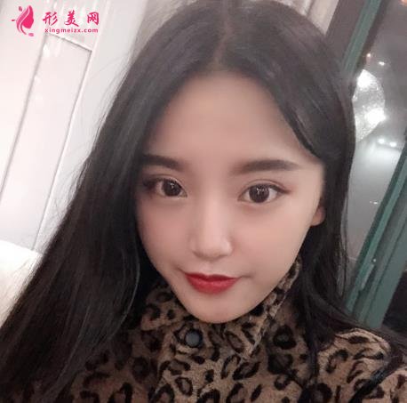 北京協(xié)和醫(yī)院雙眼皮多少錢？真人效果術(shù)后圖、價(jià)格表清單一一公布！