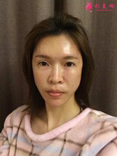 北京協(xié)和醫(yī)院脂肪填充做得好嗎？王陽醫(yī)生案例和價(jià)格表紛紛上線！