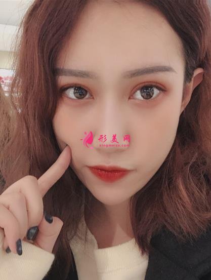 上海伊萊美醫(yī)療美容醫(yī)院做雙眼皮怎么樣？案例真實反饋_整形價格一覽