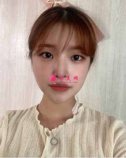 上海伊萊美李湘原做下頜角怎么樣?真人案例術(shù)后三個(gè)月效果展示