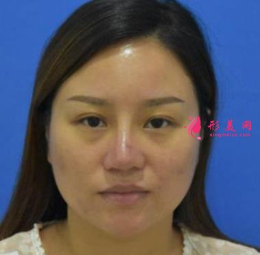 南昌大學二附院整形科去眼袋怎么樣？對比下真人案例及價格均價表