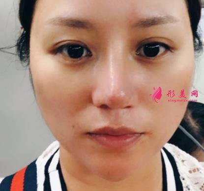 南昌大學二附院整形科去眼袋怎么樣？對比下真人案例及價格均價表