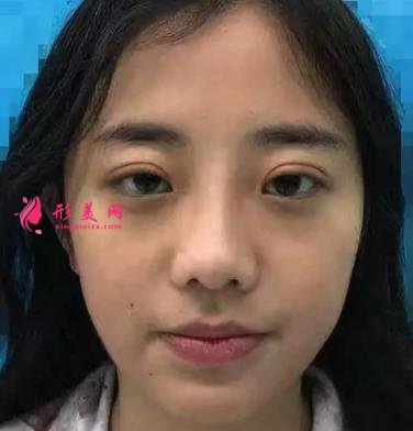 常州一院整形科做鼻子價(jià)格表2021！在分享真實(shí)案例效果圖